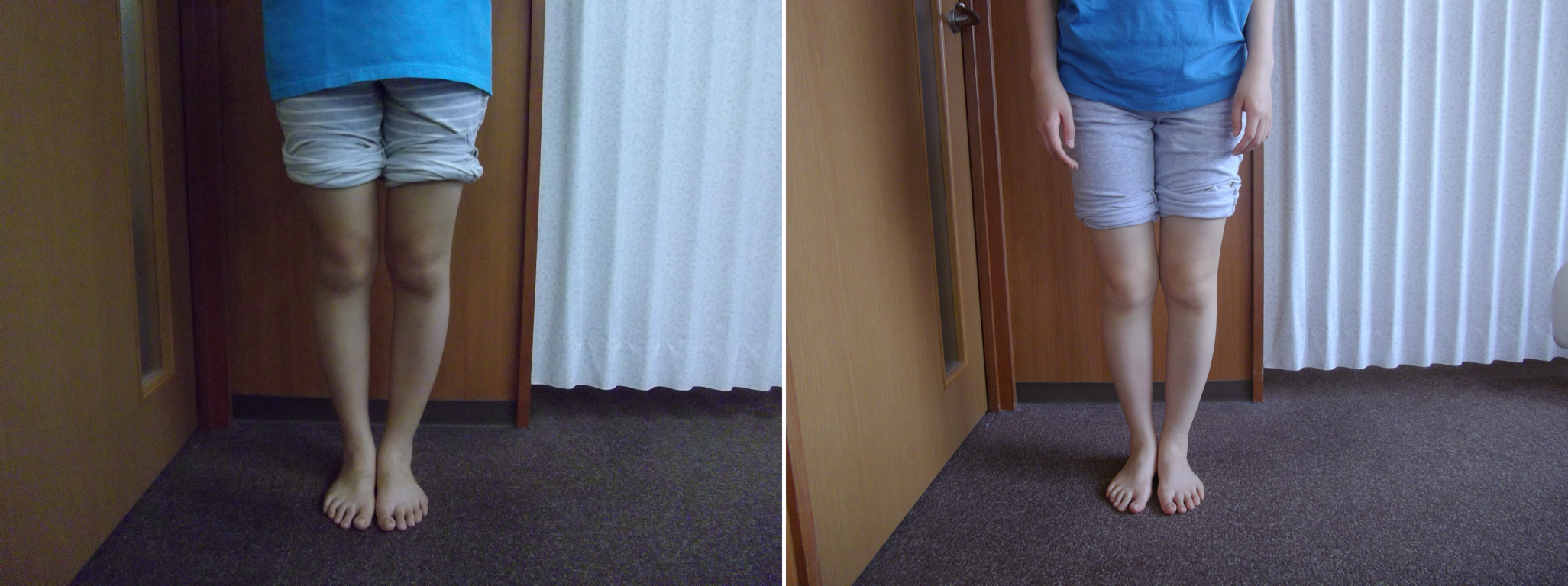 八王子 ｏ脚矯正 １０代の女子高生のビフォーアフター ｂｅａｕｔｙ 西八王子駅前整体院